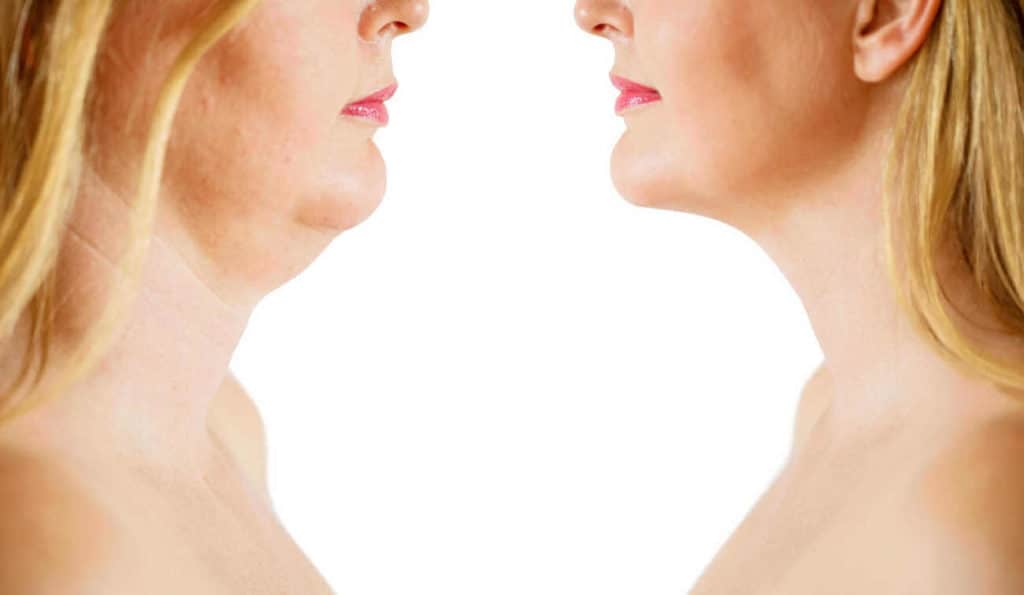 Double Chin treatment Uckfield before and after results