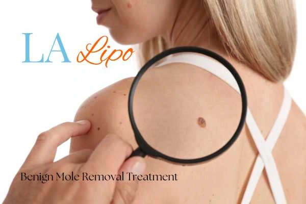 Woman having her inspection of blemish before mole removal Uckfield