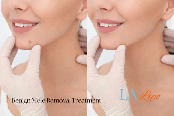 Before and after mole removal Uckfield treatment