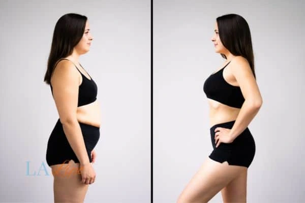 image of woman before and after results of LA-EMS Body Sculpting Uckfield to help treat Diastasis recti