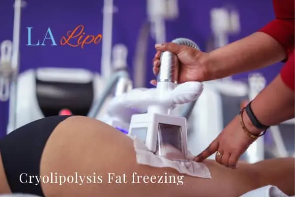 women getting fat freezing Uckfield