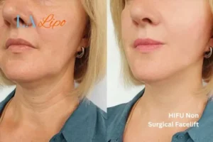 hi-fu for wrinkles Uckfield before and after results