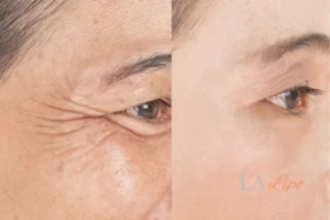 Before and after results of woman - HI-fu wrinkles reduction treatment Uckfield