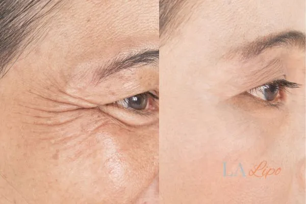 Before and after results of woman - HI-fu wrinkles reduction treatment Uckfield