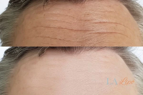 results of HIFU Uckfield on mans forehead to help reduce lines and wrinkles