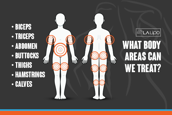Graphic to show areas you can have LA-EMS Body Sculpting Uckfield treatment.
