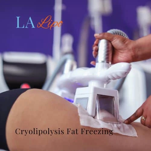 fat freezing - Cryolipolysis Uckfield