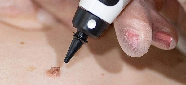 skin tag removal using cryopen Uckfield