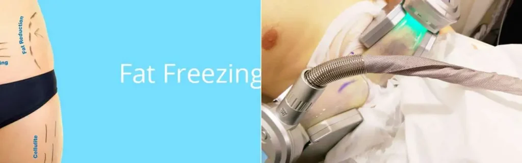 multi areas of a persons body having coolsculpting Uckfield treatment