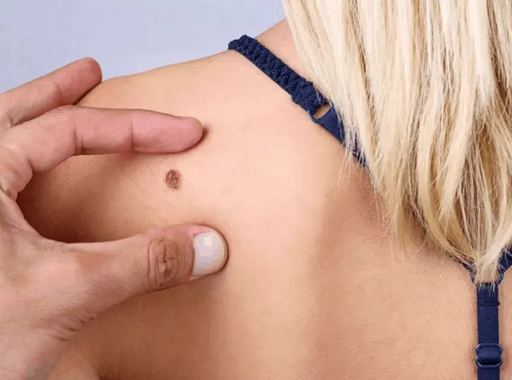 woman having mole removal Uckfield consultation before treatment.