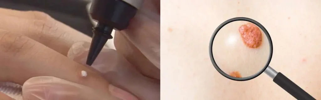 Cryopen for mole removal Uckfield - speak to our team today!