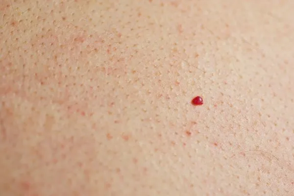 close up of a cherry angioma Uckfield
