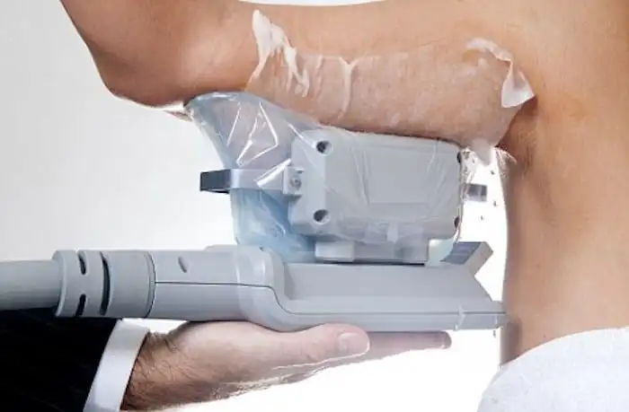 Picture of fat freezing Uckfield on the upper arms.
