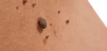 image of a skin tag Uckfield