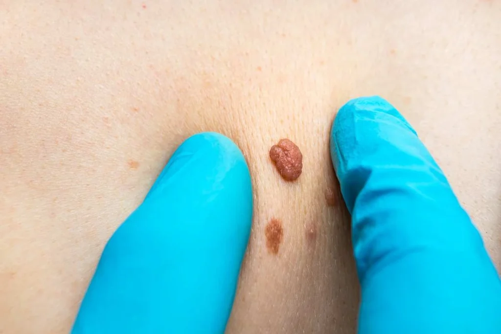 Consultant examining a skin tag Uckfield
