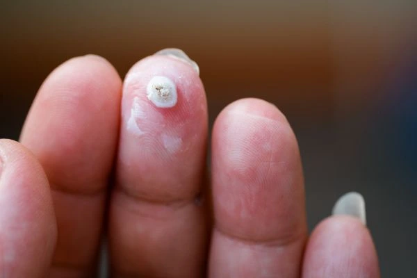 wart on person finger - cryotherapy to treat from LA LIPO Uckfield