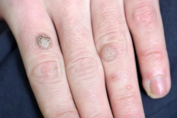 photo of warts on person hand - see wart removal Uckfield from LA LIPO