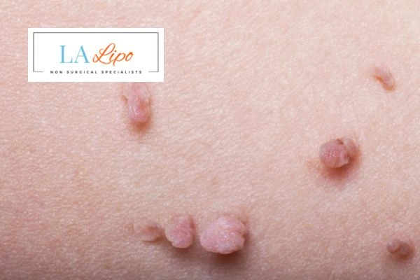 Does cryopen skin tag removal Uckfield hurt? Find out now call our team today!