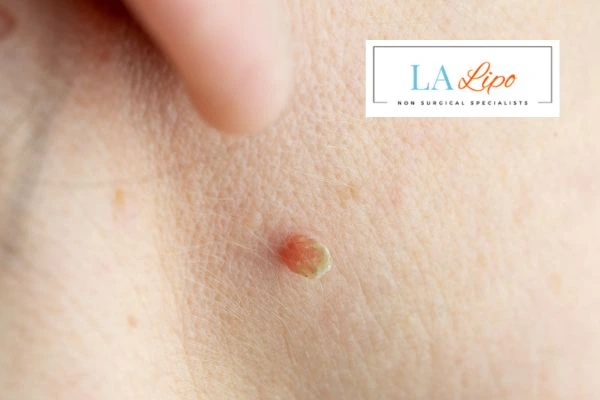 Book skin tag removal Uckfield today speak to our team now!