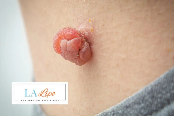 Interested in skin tag removal Uckfield? Concerned about the pain? Find out more today!