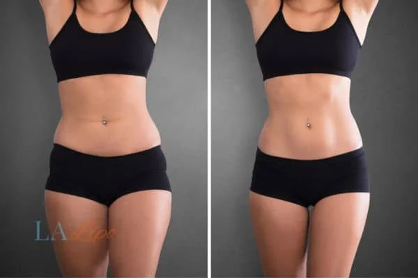 before and after results of non-surgical treatment to help a woman's body image and mental health Uckfield