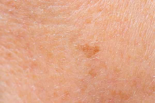 close up picture of age spots Uckfield