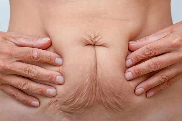 Image of a woman's stomach with loose skin - example of skin tightening Uckfield options