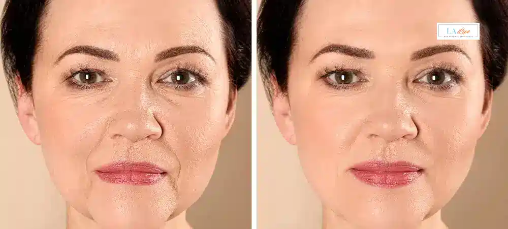 How Long Does It Take to See Results and How Long Do They Last Uckfield?
