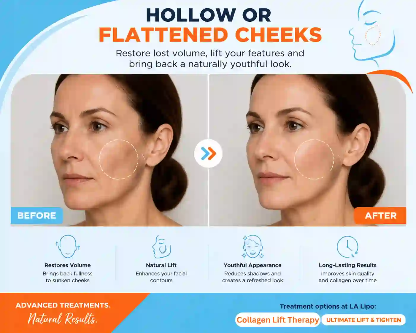 Sign #4: Hollow or Flattened Cheeks Uckfield
